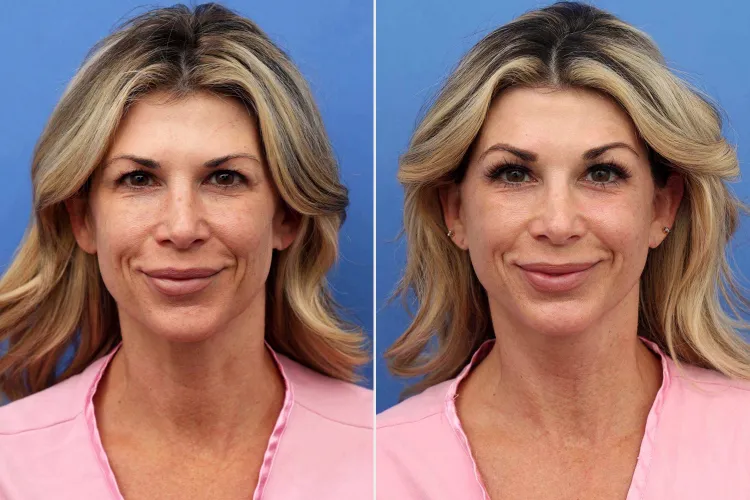 alexis bellino mid-facelift